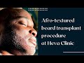 African american beard transplant in turkey  facial hair transplant procedure at heva clinic