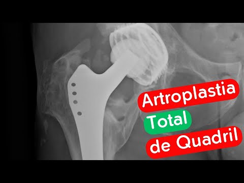 Vídeo: Reavaliando A Abordagem Do Consentimento Informado: O Caso De Transplante De Células-tronco Hematopoiéticas Não Relacionadas Em Pacientes Adultos Com Talassemia