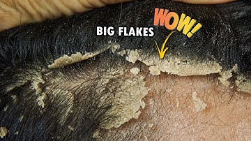 Itchy Dry Scalp Scratching Dandruff Satisfying #712