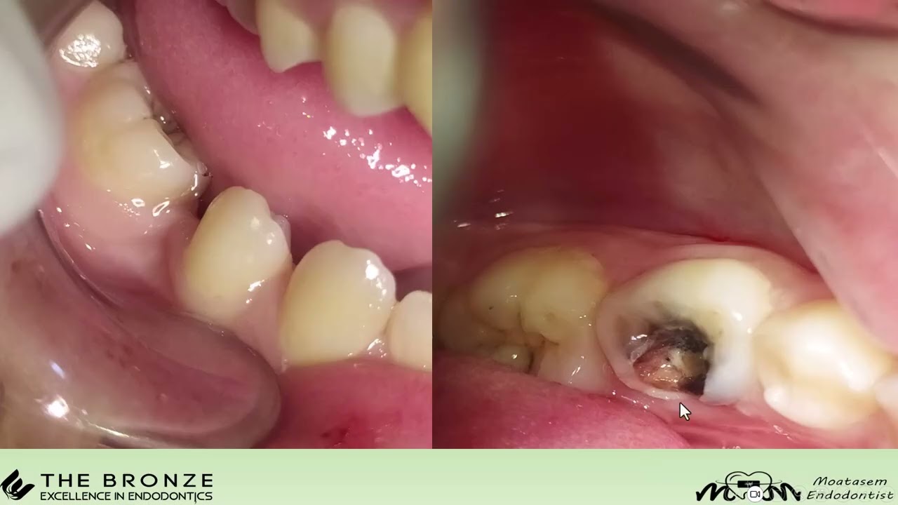 المداواة اللبية للأسنان اللبنية غير المستبدلة . د. معتصم حسن المرعي