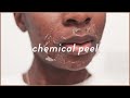 I Tried The STRONGEST VI Peel 😰 | Chemical Peel Before and After For Acne & Acne Scars