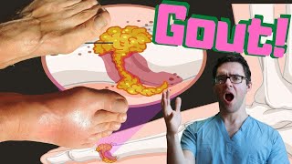 Gout ATTACK & Gout Big Toe Joint TREATMENT 2022! [Gout FOOT Treatment]