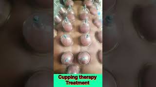 cupping therapy #foryou #improve #circulation #DropsinghLoverpublic #youtubeshorts