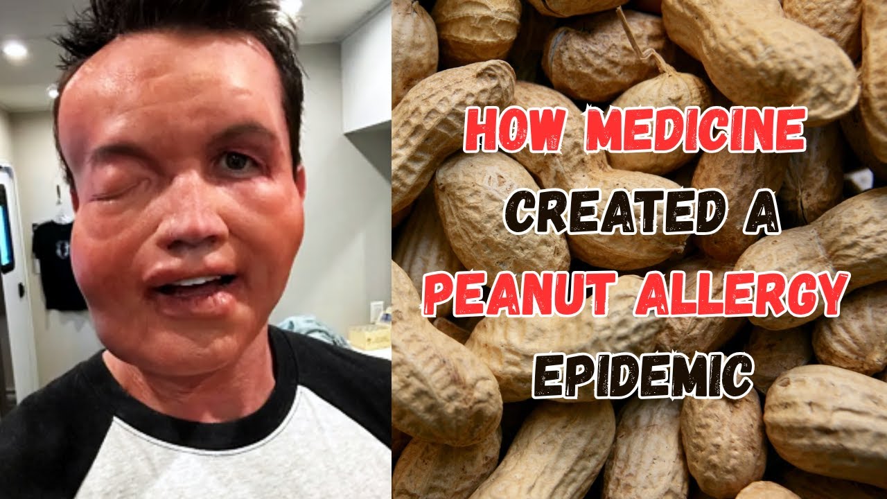 The Rise of The Peanut Allergy Epidemic