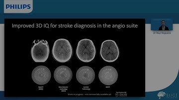 Direct to Angio Suite Triage for Faster Stroke Treatment - SLICE Worldwide 2020