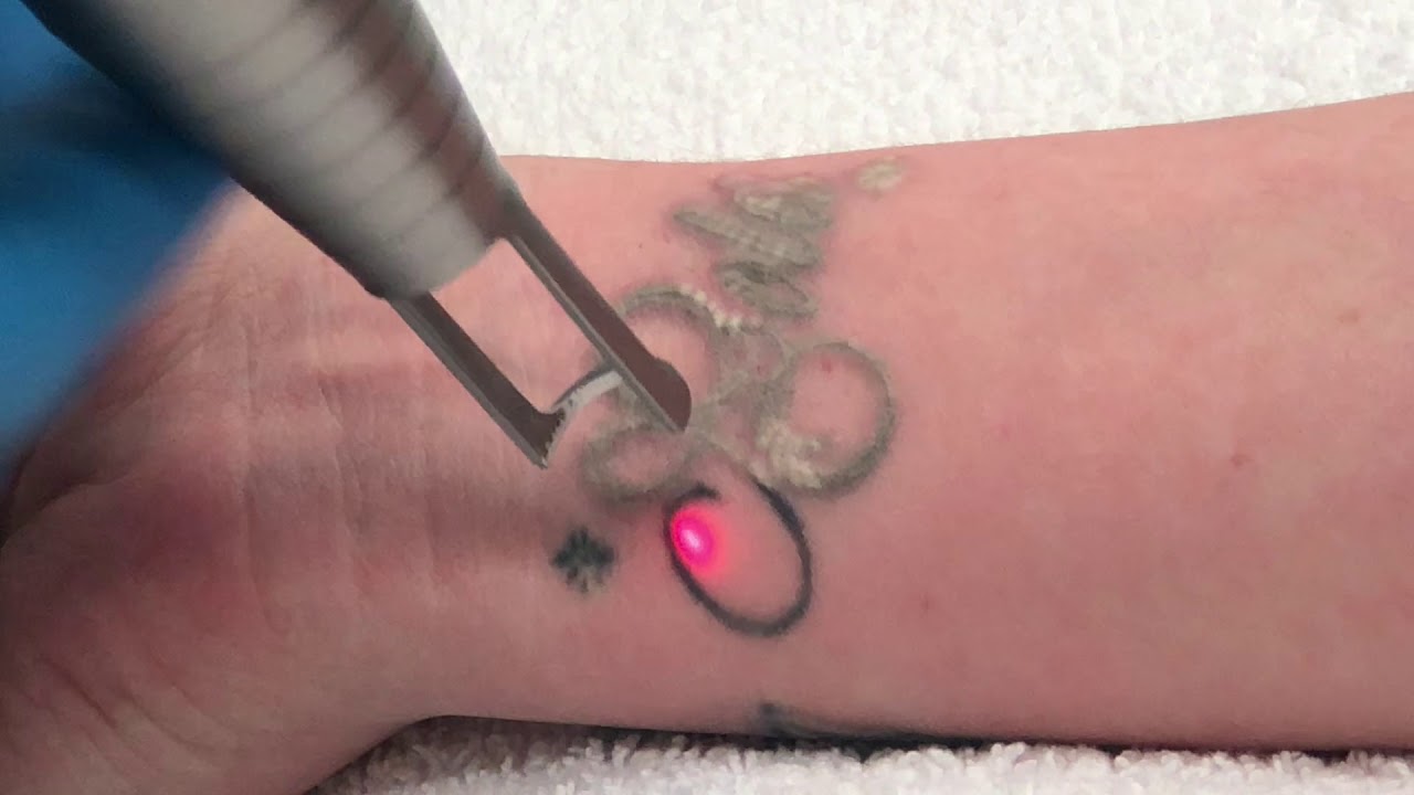 Tattoo Removal Bristol Va Tattoo Removal Swansea Ma