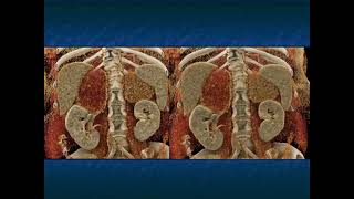 CT of the Large Adrenal Mass: Follow, Biopsy, Resect - Part 3