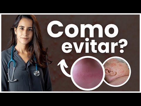 BROTOEJAS em RECÉM NASCIDOS: Quais as principais CAUSAS + COMO TRATAR? | Dra Jannuzzi