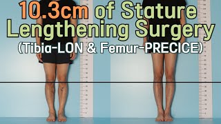 Growing 10.3cm Taller by Stature Lengthening Surgery with LON and PRECICE