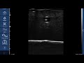 US guided puncture