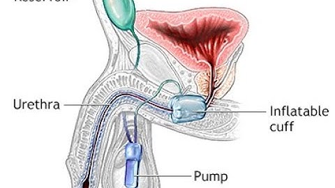 Insertion of Tandem cuff CPT code - simplify medical coding
