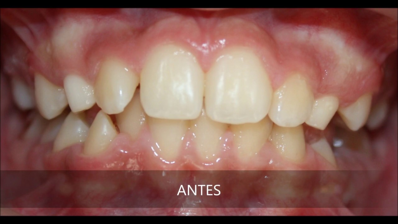 Caso clínico con dentición mixta - YouTube