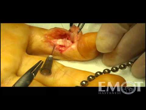 EMOT Hastanesi Doç. Dr. Murat KAYALAR  &rsquo;&rsquo;Fleksör Tendon Onarımı&rsquo;&rsquo;