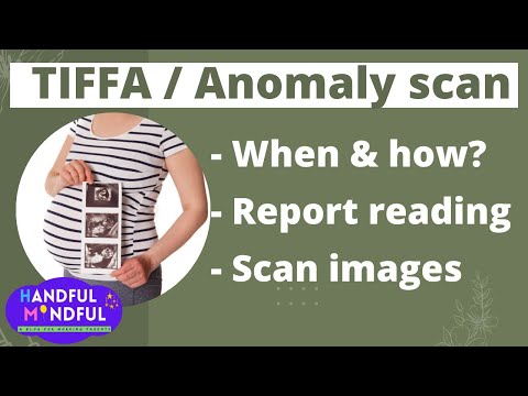 Video: Sarcina dvs. cu ultrasunete Scan Photo Explained