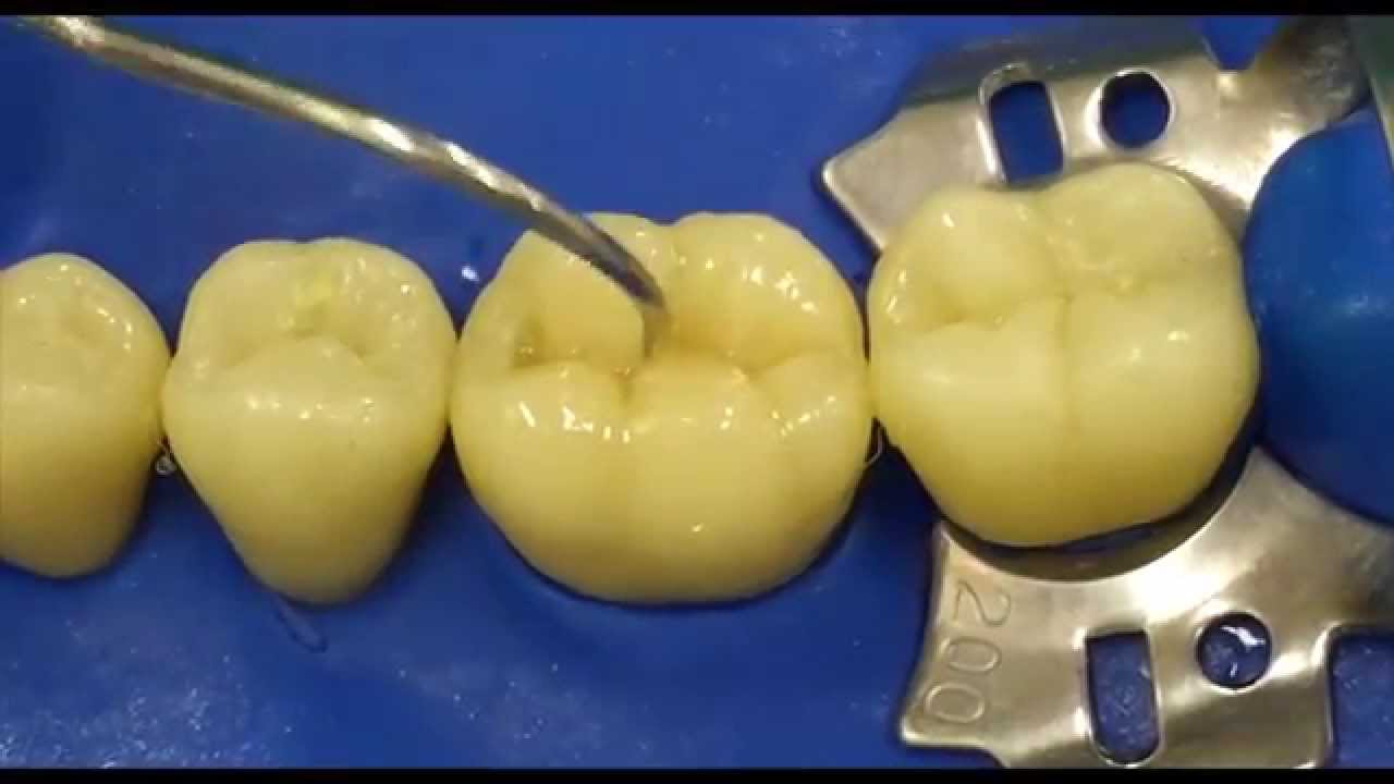 Occlusal Anatomy Reconstruction YouTube