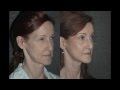 Facelift Before and After Long Island New York