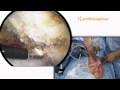 Shoulder Arthroscopy: Subacromial Decompression Distal Clavical Excision by Scott Trenhaile, MD