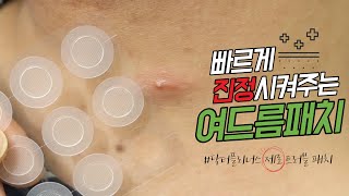 💢여드름진정 빠르게 하고싶을때 닥터플리너스 제로 트러블패치🚑