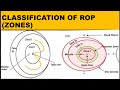 Zones in retinopathy of prematurity  rop