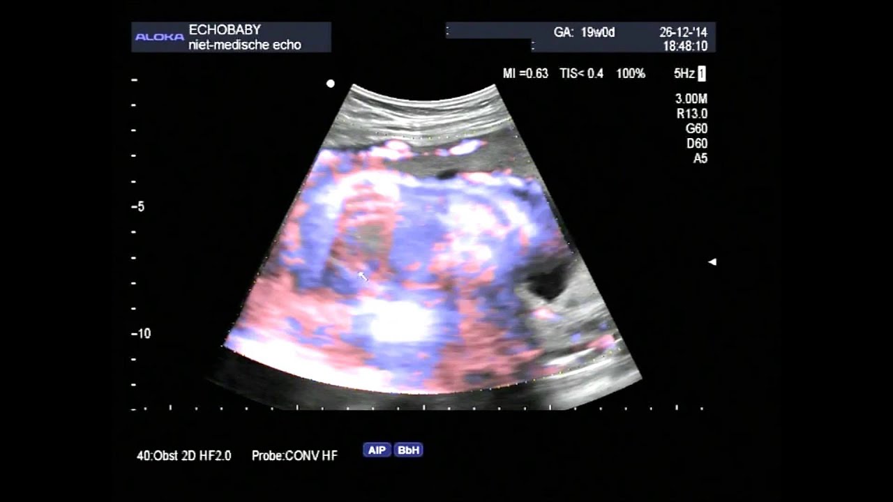 2D echo 19 weken, met ingesproken uitleg