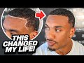 Secret Hairline Transformation Procedure Changed My Life!