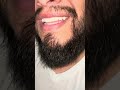 Barba después de ya no usar Minoxidil !  REALES | AguacatinaBarba  #beard #natural| 39 de 365 Dias