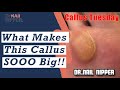 What makes this Callus SOOO Big ??