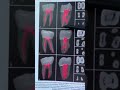 Анатомия корневых каналов на нижней челюсти(Премоляры , моляры)