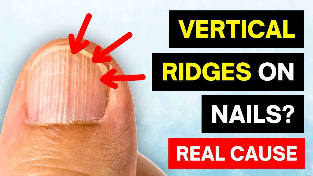 covid 19: Observing changes in fingernails? Red half-moon-shaped marks,  ridges and white lines may be due to Covid - The Economic Times