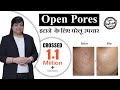 Open Pores Treatment by Doctors | How to reduce Open Pores Video in Hindi