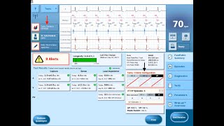 Deactivation and reactivation of ICD