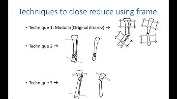 Ilizarov surgical principles and techniques