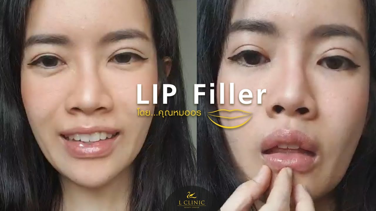 รีวิว Lip Filler Augmentation👄 โดย คุณหมออร [L Clinic Beauty Center