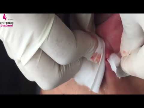 Severe acne & Whitehead Removal on the nose