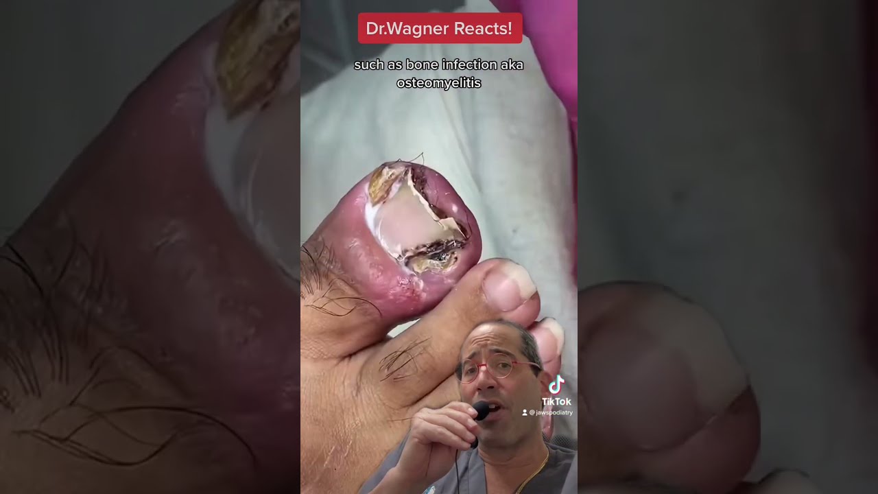 SUPER INFECTED INGROWN TOENAIL Shorts Ingrown Toenail