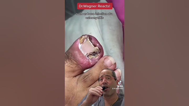 SUPER INFECTED INGROWN TOENAIL😳#shorts #ingrown_toenail