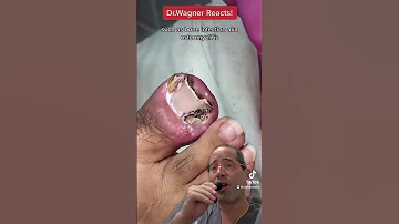 SUPER INFECTED INGROWN TOENAIL Shorts Ingrown Toenail 