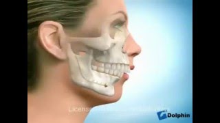 Excesso mandibular - Deficiência maxilar - Classe III - Dra