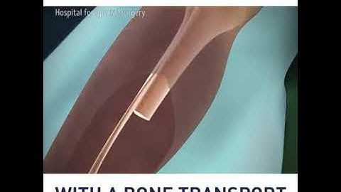 bone transport technique.....