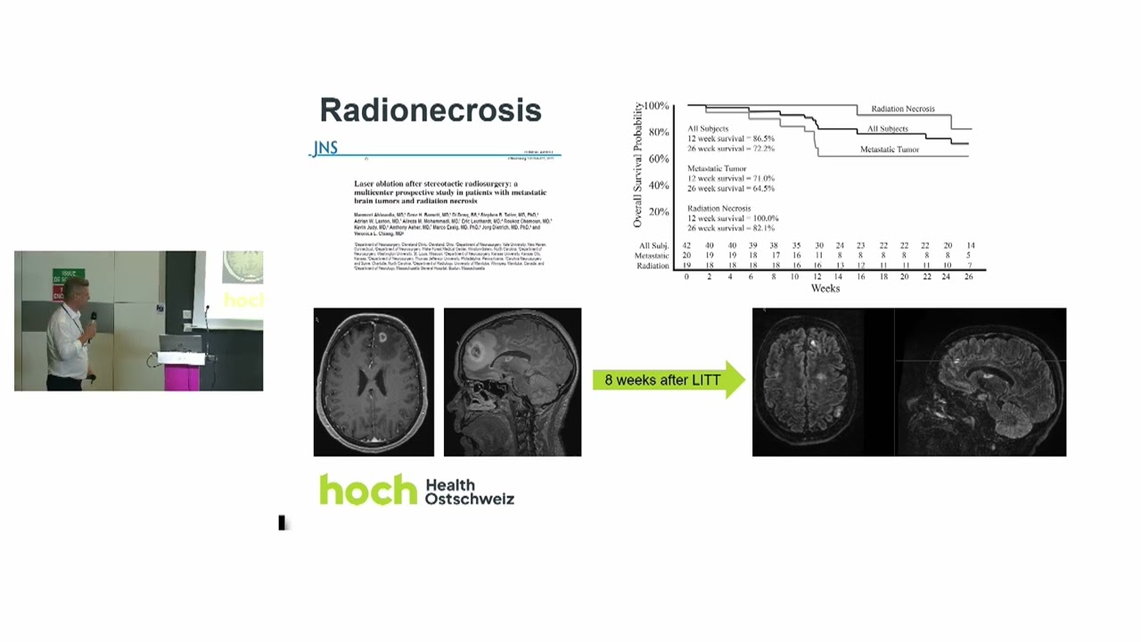 Brain Metastasis, Indications and results of LITT for brain metastasis and radionecrosis.