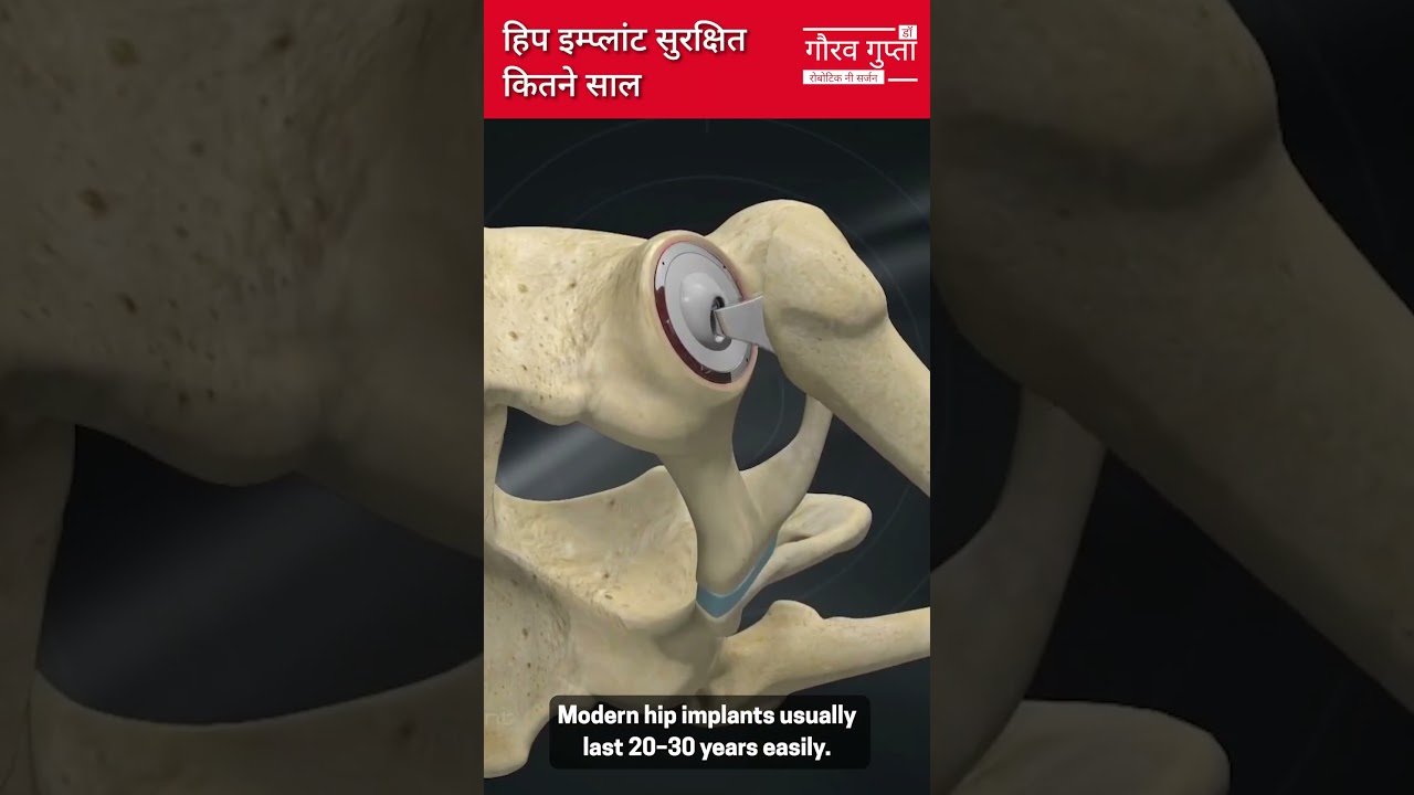 हिप इम्प्लांट सुरक्षित कितने साल | Hip Implant Life