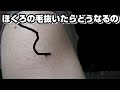 【解説】ほくろの毛抜いたらどうなるの!?