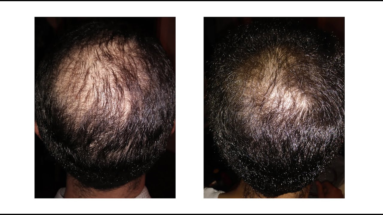 More Hair Naturally Before And After Photos Youtube
