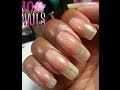 Vertical Nail Ridging, What Is This? - Dr. Jacoby - YouTube