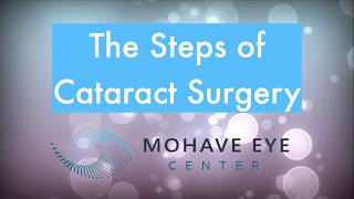 Steps of Cataract Surgery│English Version