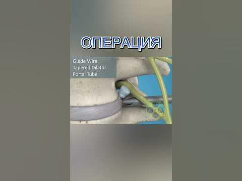 ДИСКОВА ХЕРНИЯ ОПЕРАЦИЯ - YouTube