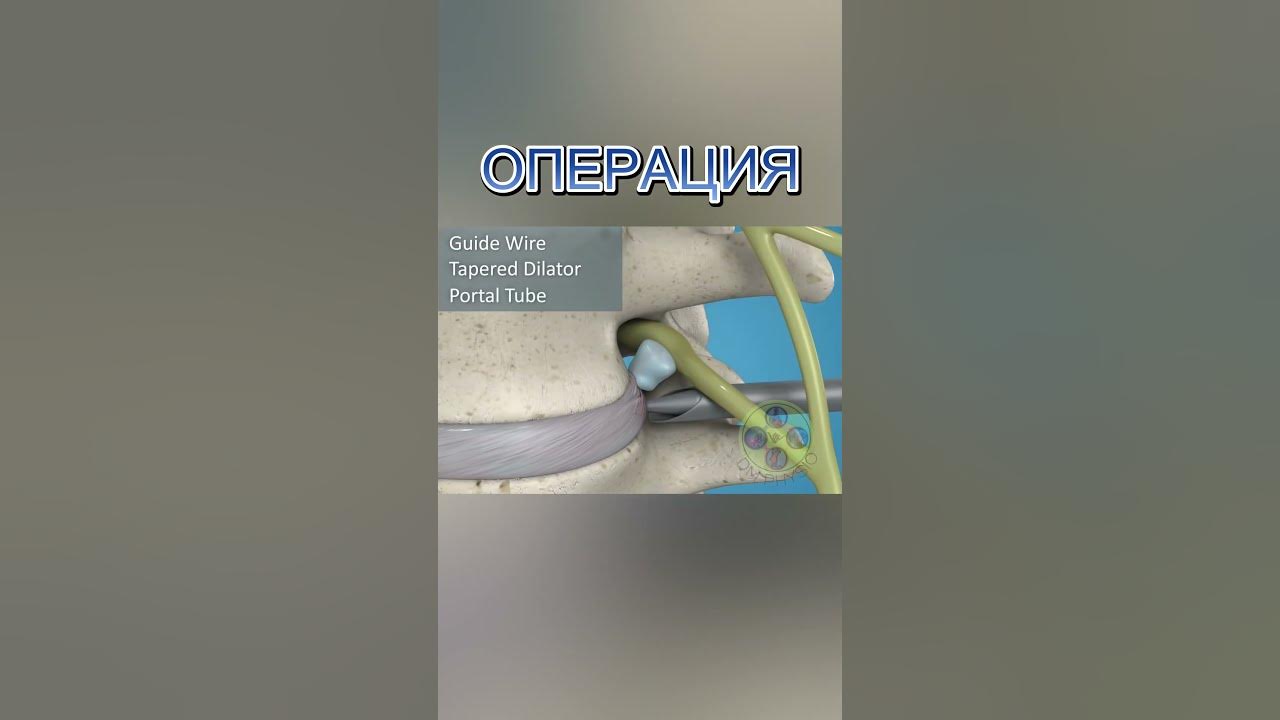 ДИСКОВА ХЕРНИЯ ОПЕРАЦИЯ - YouTube