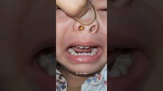 Something Stuck In Nose   How Doctor Remove It         