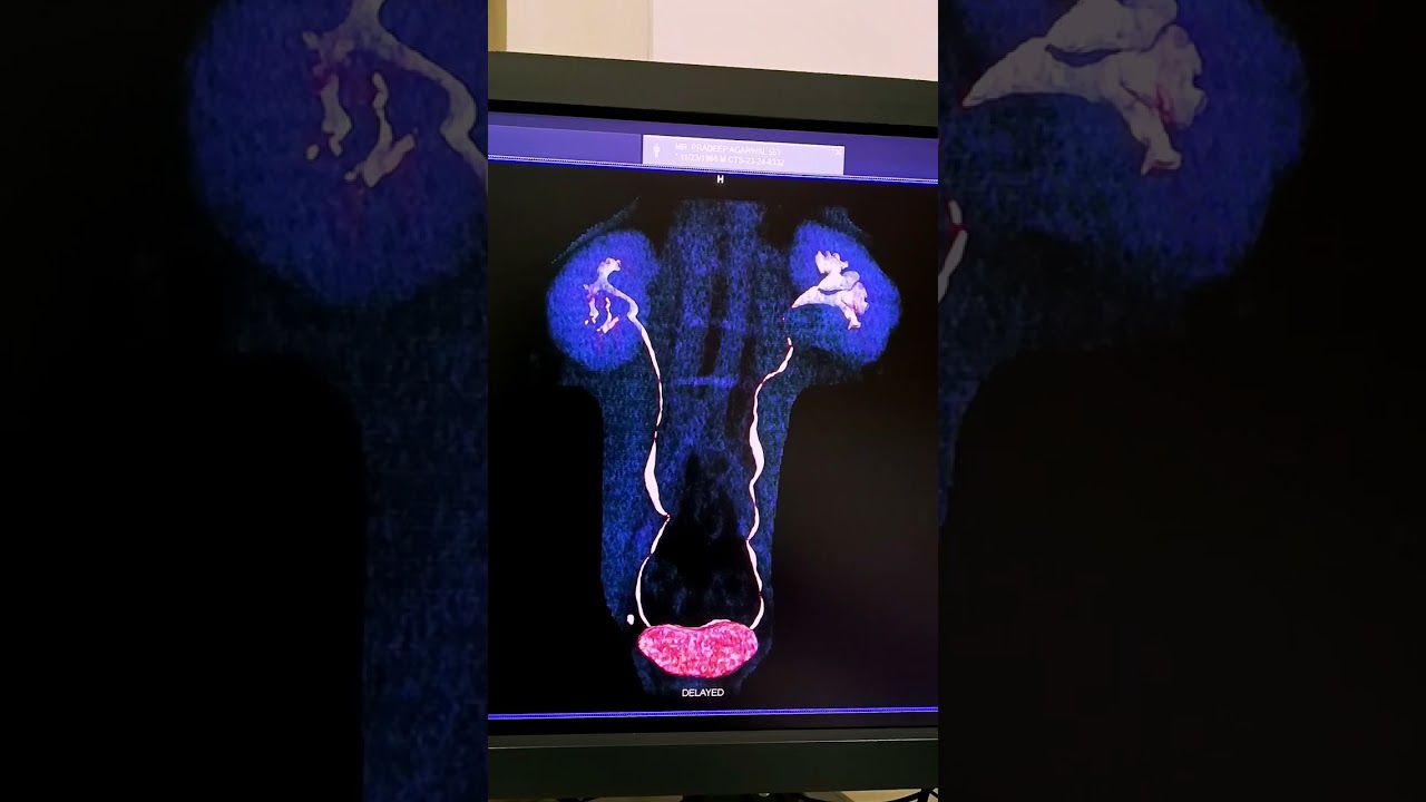 urography Ct scan of urogram | urology 