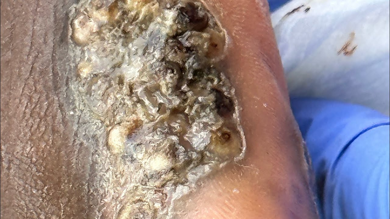 Jigger digging Randon's right foot YouTube